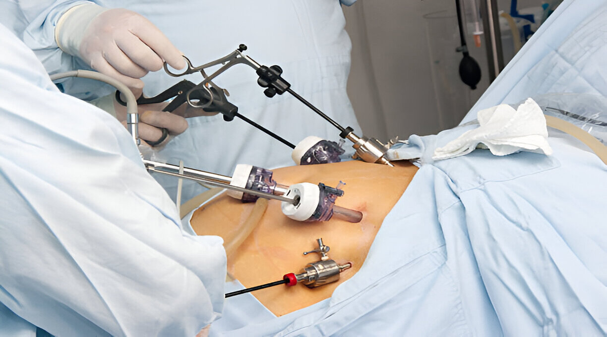 Laparoscopic surgery