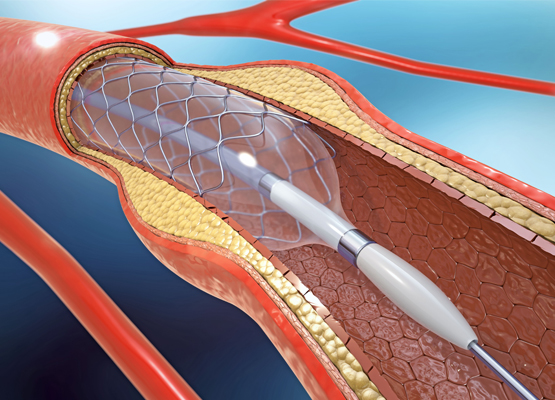 Keyhole Angioplasty