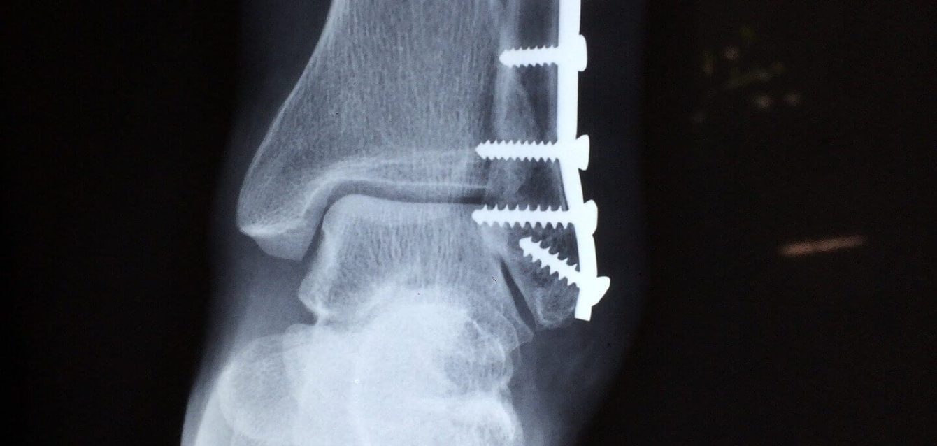 Bone fracturers