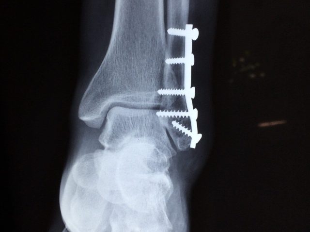 Bone fracturers