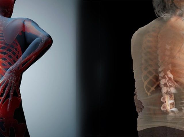 Osteoporosis