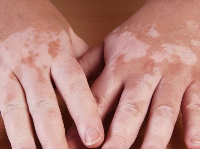 VITILIGO