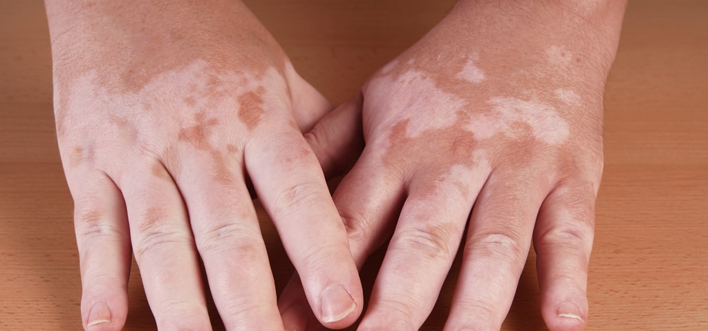 VITILIGO