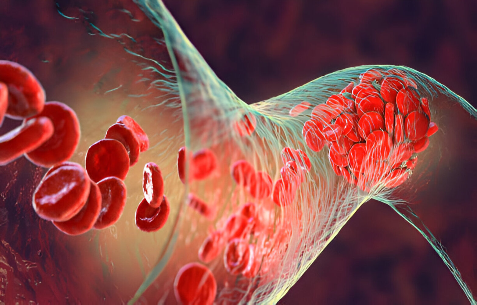 Pulmonary hypertension