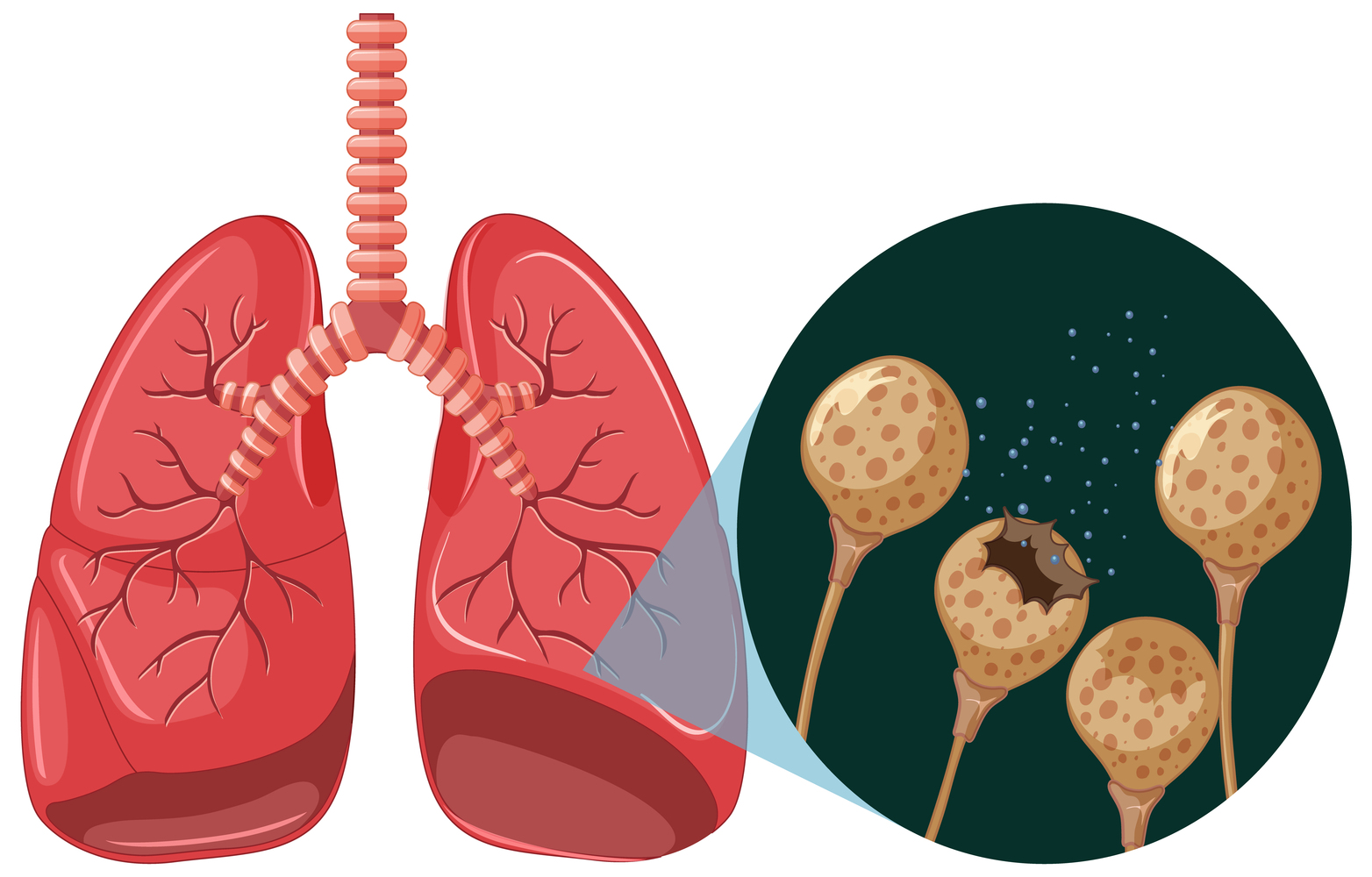 Pulmonary Fibrosis